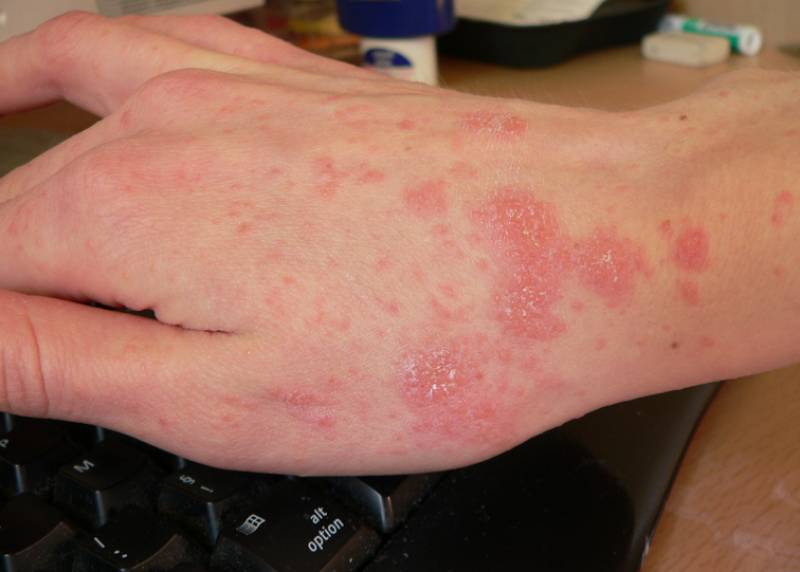 Scabies infections explode in Spain