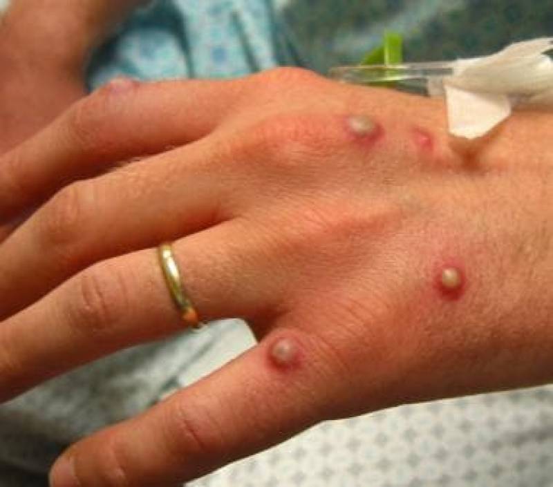 <span style='color:#780948'>ARCHIVED</span> - First suspected case of monkeypox detected in Alicante