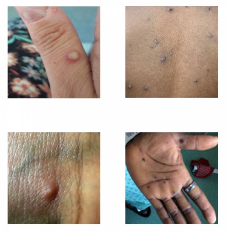 <span style='color:#780948'>ARCHIVED</span> - Monkeypox: Second Region of Murcia case confirmed in a 50-year-old