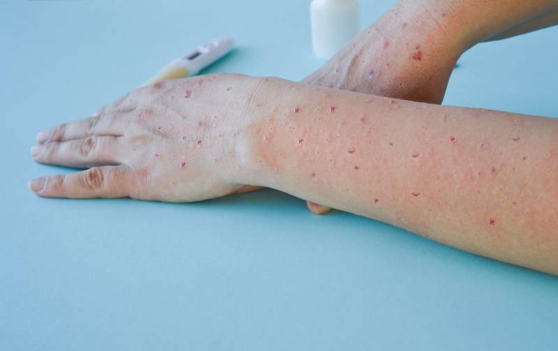 <span style='color:#780948'>ARCHIVED</span> - Monkeypox: Third case confirmed in the Region of Murcia and two others under investigation