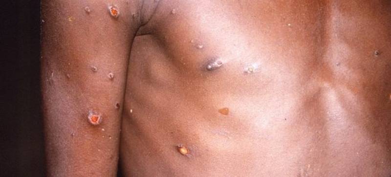 <span style='color:#780948'>ARCHIVED</span> - Monkeypox cases in Spain approach 6,750 - the highest in Europe