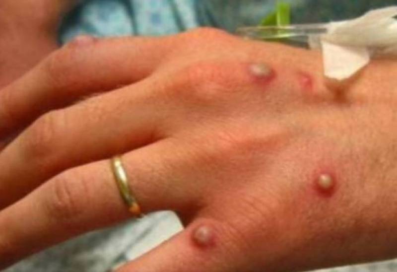 Murcia pushes for mpox vaccine as fears of infection grow